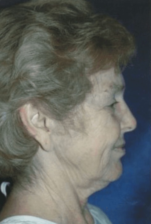 Case--3226 | Before Neck Lift