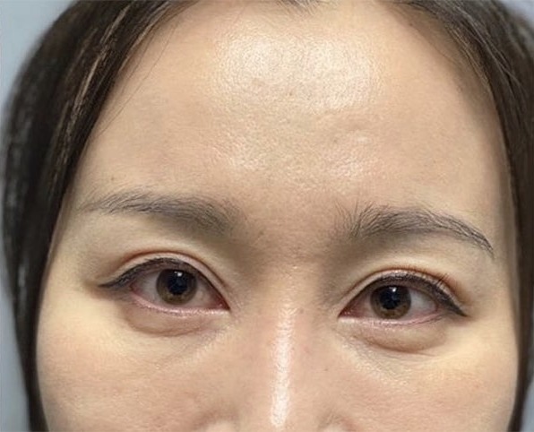 Case--4022 | After Blepharoplasty