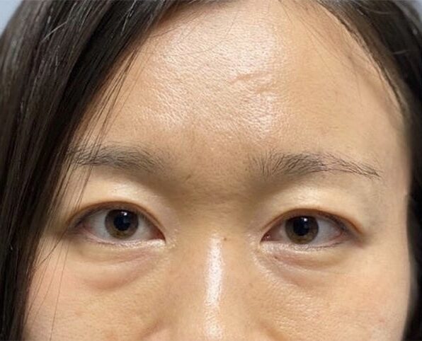 Case--4022 | Before Blepharoplasty