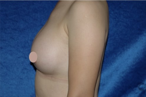 Case--4451 | After Breast Augmentation