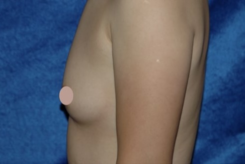 Case--4451 | Before Breast Augmentation