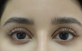 Case--6473 | After Blepharoplasty