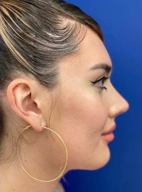 Case--8211 | After Rhinoplasty