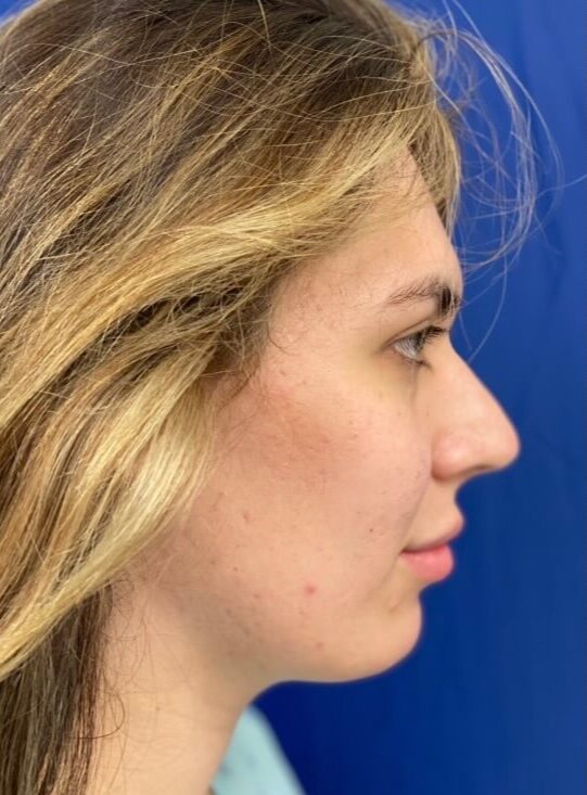 Case--8211 | Before Rhinoplasty