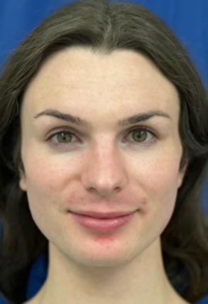 Case--5794 | Before Facial Feminization Surgery