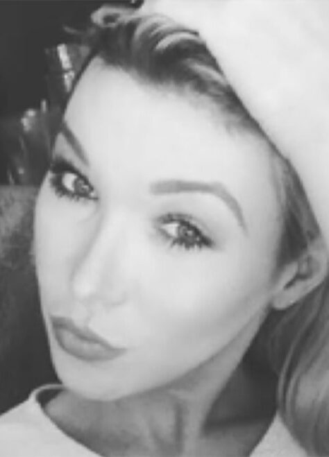 Case--5362 | After Jaw Reduction