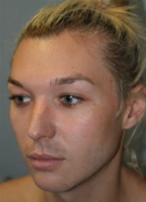 Case--5362 | Before Jaw Reduction