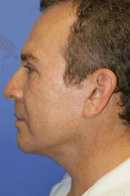 Case--1573 | After Neck Lift