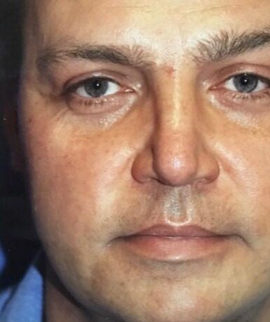 Case--7250 | After Rhinoplasty