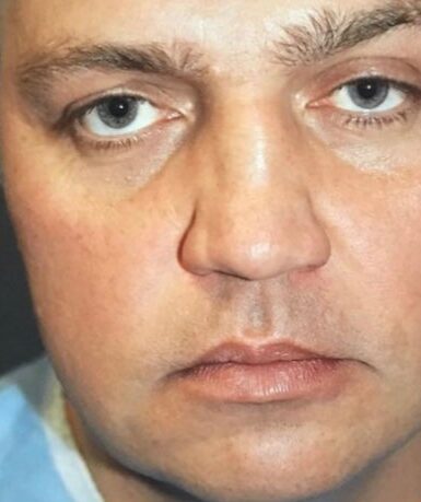 Case--7250 | Before Rhinoplasty