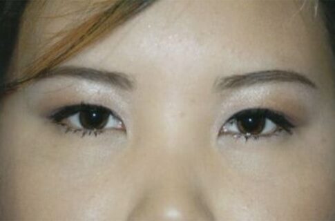 Case--1764 | After Blepharoplasty