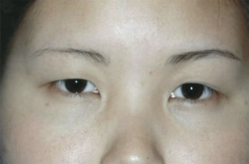 Case--1764 | Before Blepharoplasty