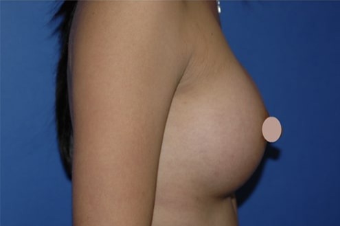 Case--6658 | After Breast Augmentation