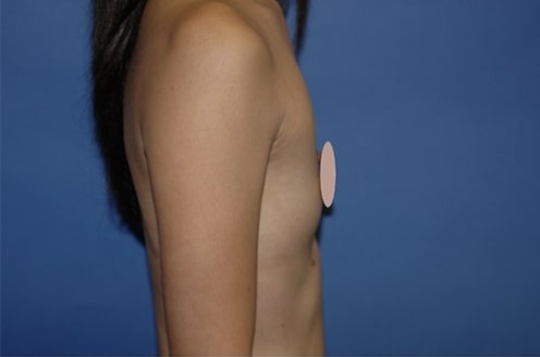 Case--6658 | Before Breast Augmentation