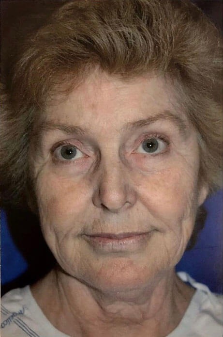 Case--2844 | Before Facelift