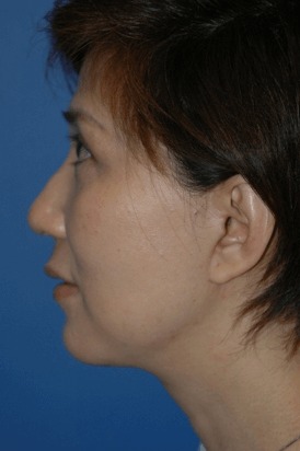 Case--5515 | After Neck Lift