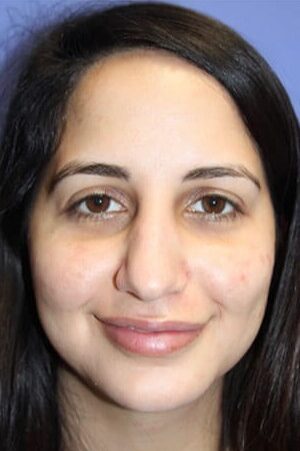 Case--2336 | Before Rhinoplasty