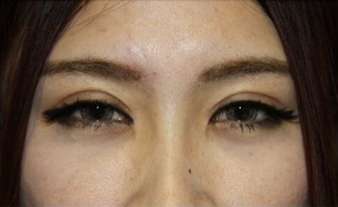 Case--9723 | After Blepharoplasty