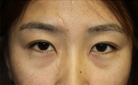 Case--9723 | Before Blepharoplasty