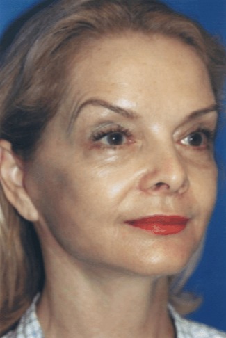 Case--5892 | After Facelift