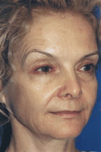 Case--5892 | Before Facelift