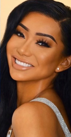 Case--7881 | After Facial Feminization Surgery