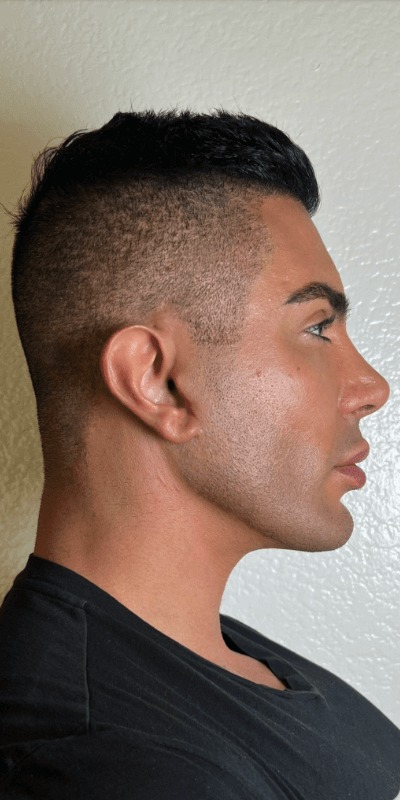 Case--3300 | After Neck Lift