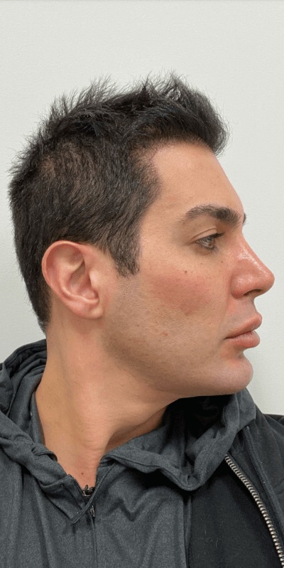 Case--3300 | Before Neck Lift