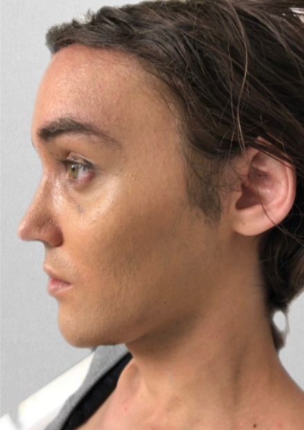 Case--3679 | After Rhinoplasty