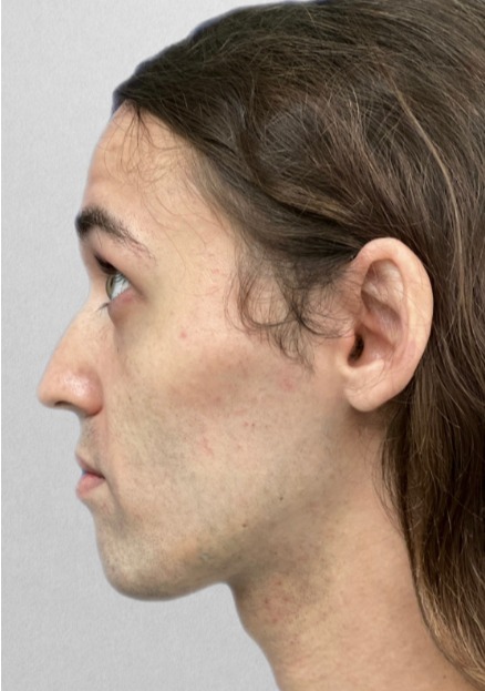 Case--3679 | Before Rhinoplasty