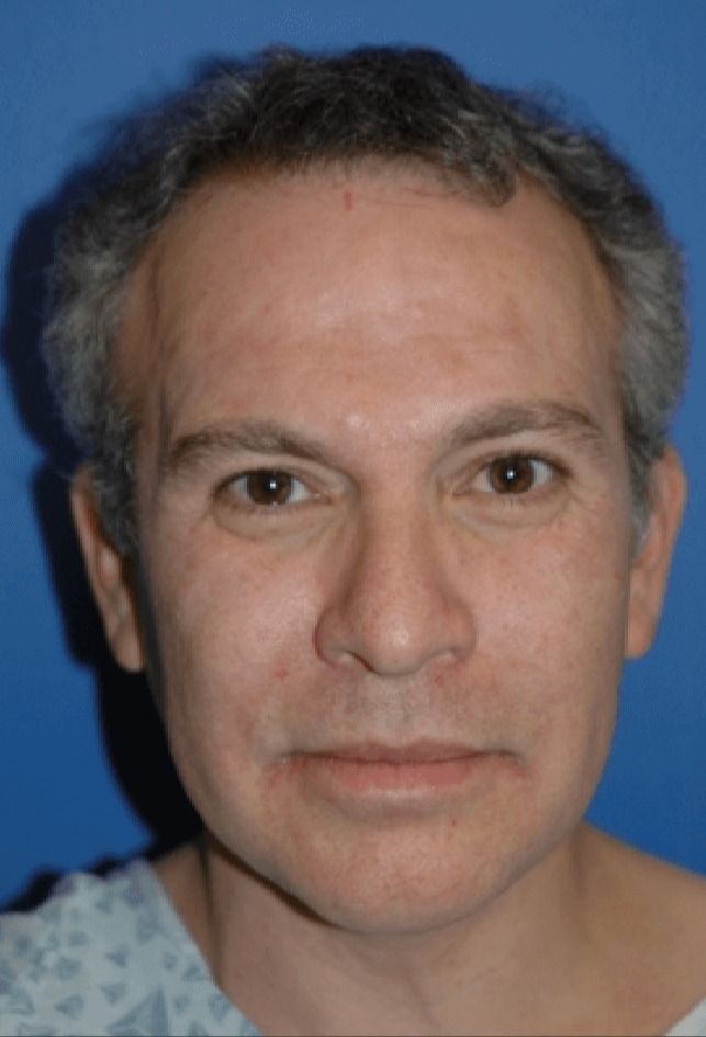 Case--6097 | After Facelift