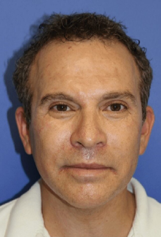 Case--6097 | Before Facelift