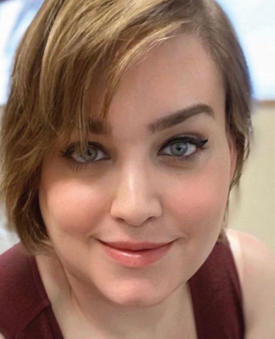 Case--7442 | After Facial Feminization Surgery