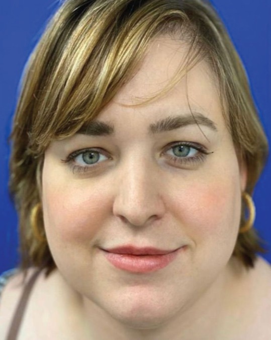 Case--7442 | Before Facial Feminization Surgery