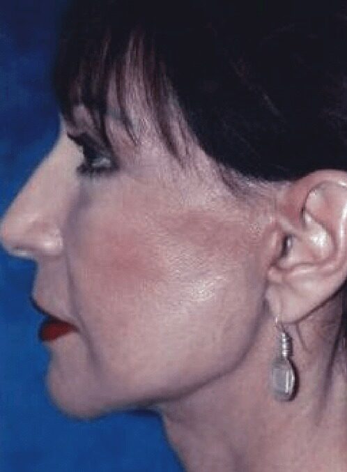 Case--8706 | After Facelift