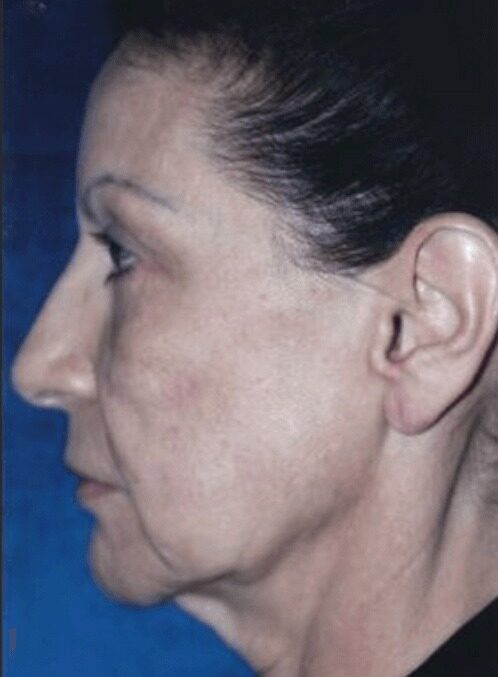 Case--8706 | Before Facelift