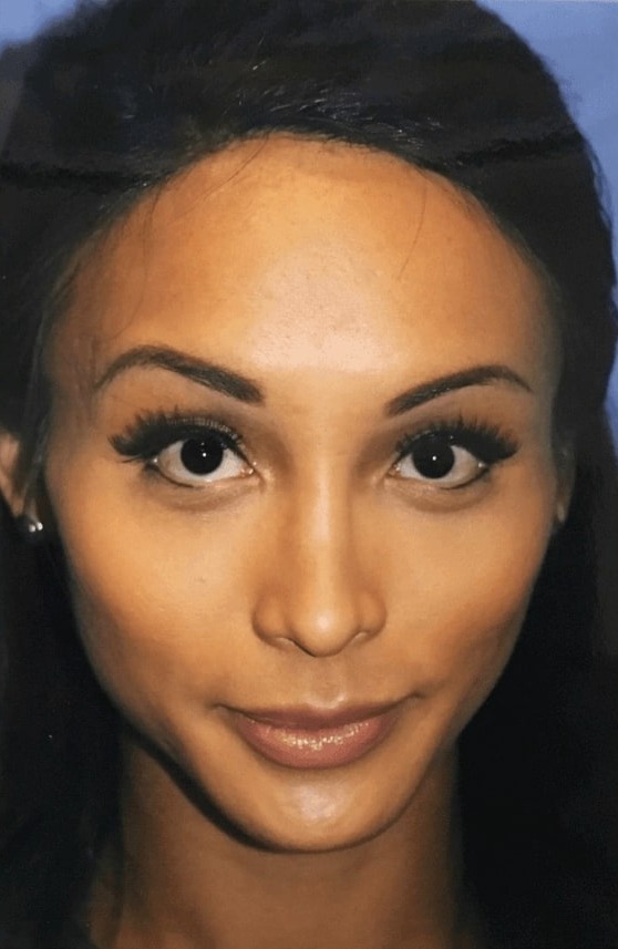 Case--8185 | After Facial Feminization Surgery