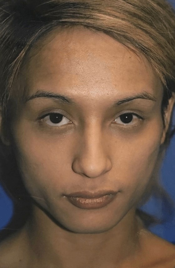 Case--8185 | Before Facial Feminization Surgery