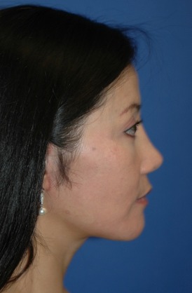 Case--5850 | After Rhinoplasty