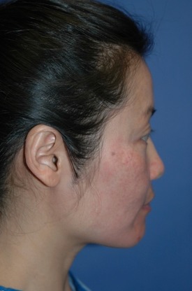 Case--5850 | Before Rhinoplasty