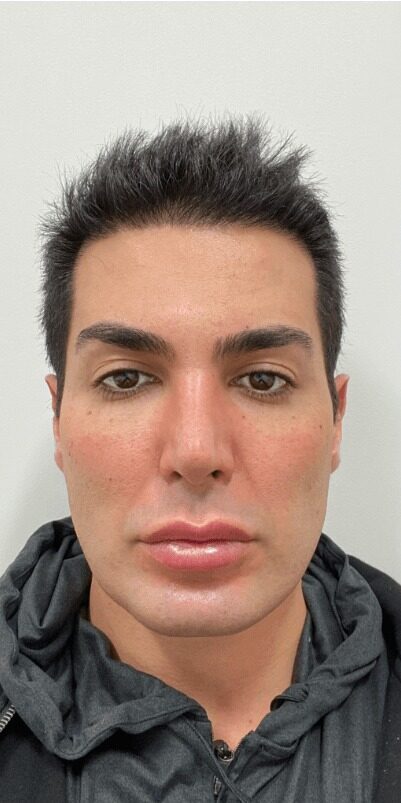 Case--4121 | Before Facelift