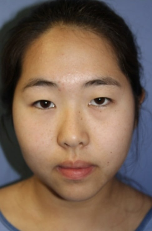 Case--5920 | Before Rhinoplasty