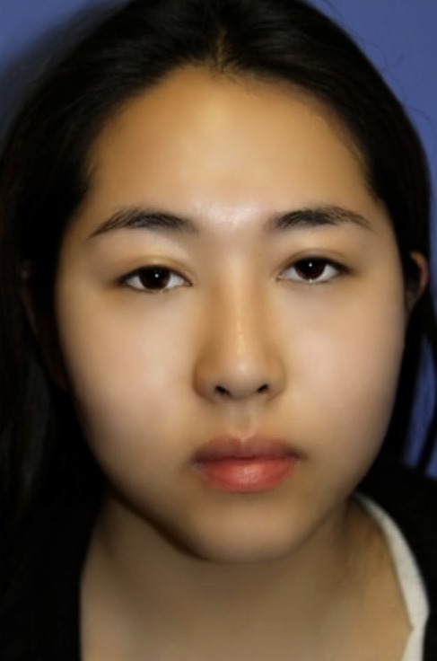 Case--5920 | After Rhinoplasty