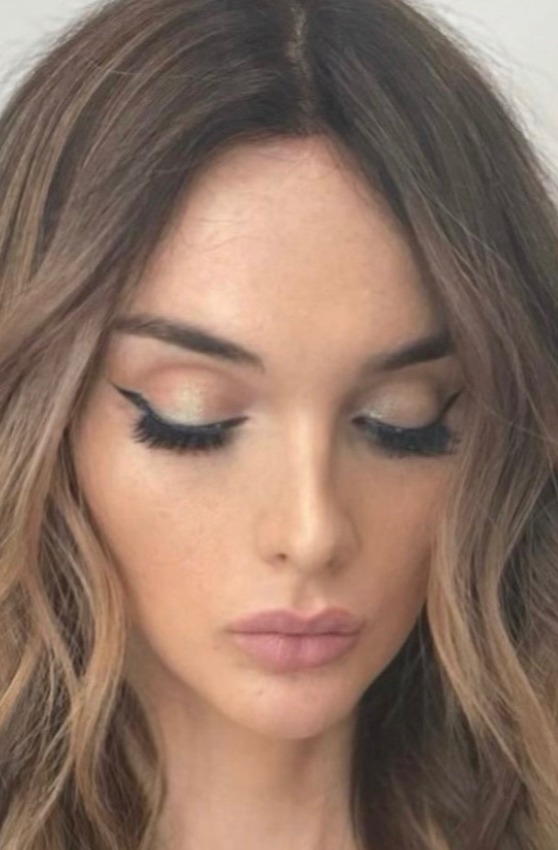 Case--8172 | After Facial Feminization Surgery