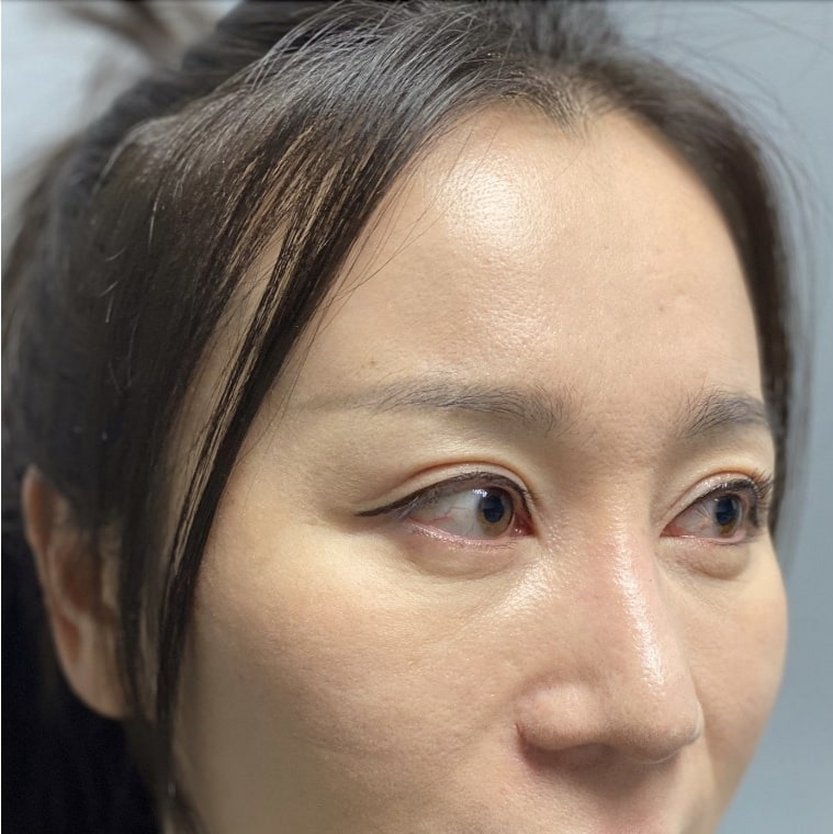 Case--3202 | After Rhinoplasty