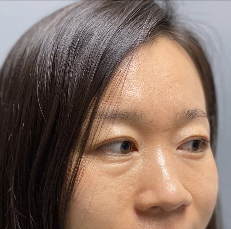 Case--3202 | Before Rhinoplasty