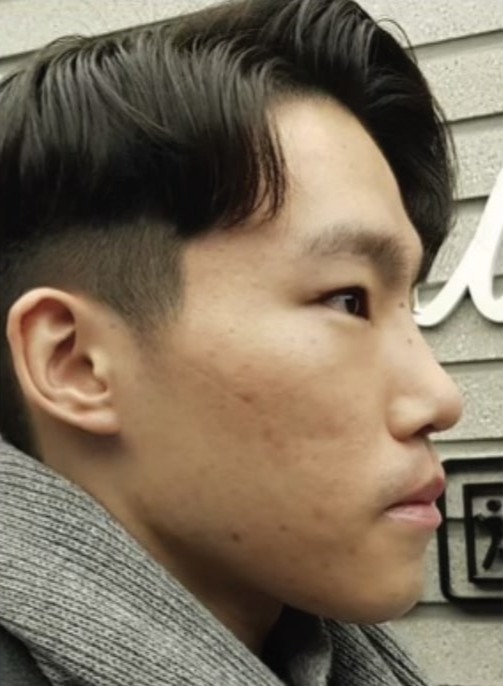 Case--7092 | After Rhinoplasty