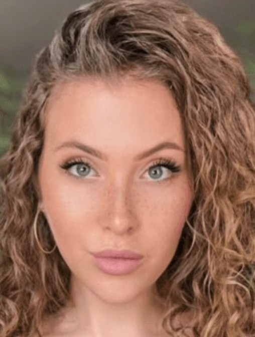 Case--3915 | After Facial Feminization Surgery