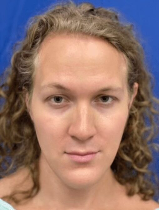 Case--3915 | Before Facial Feminization Surgery