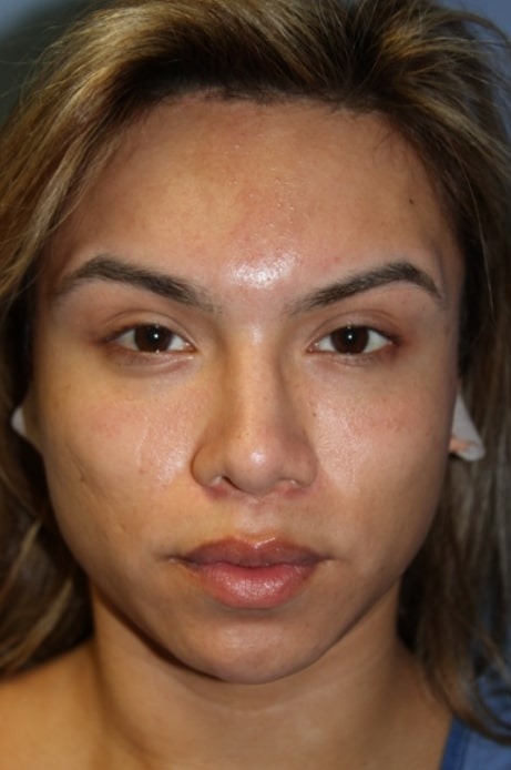 Case--4656 | Before Facial Feminization Surgery